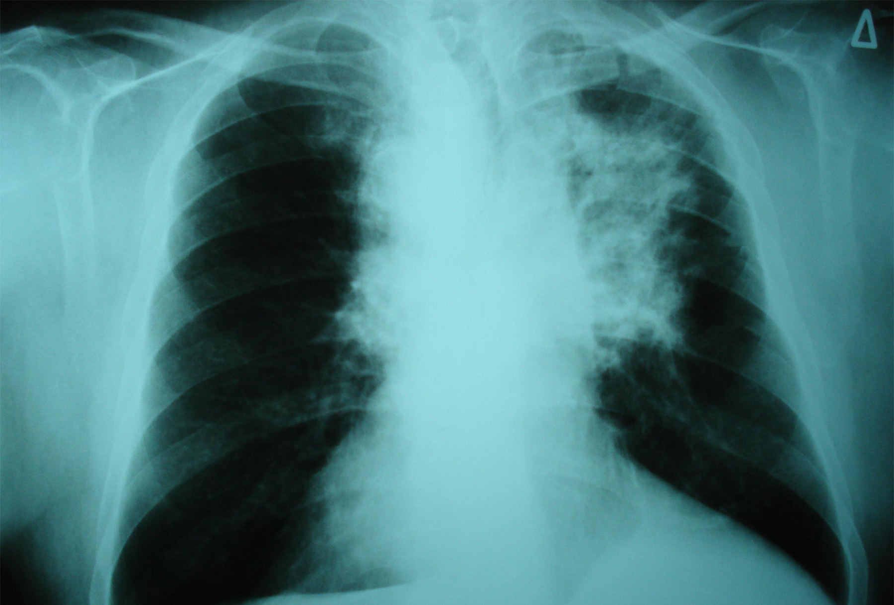 chest x ray showing a tumour in the left lung